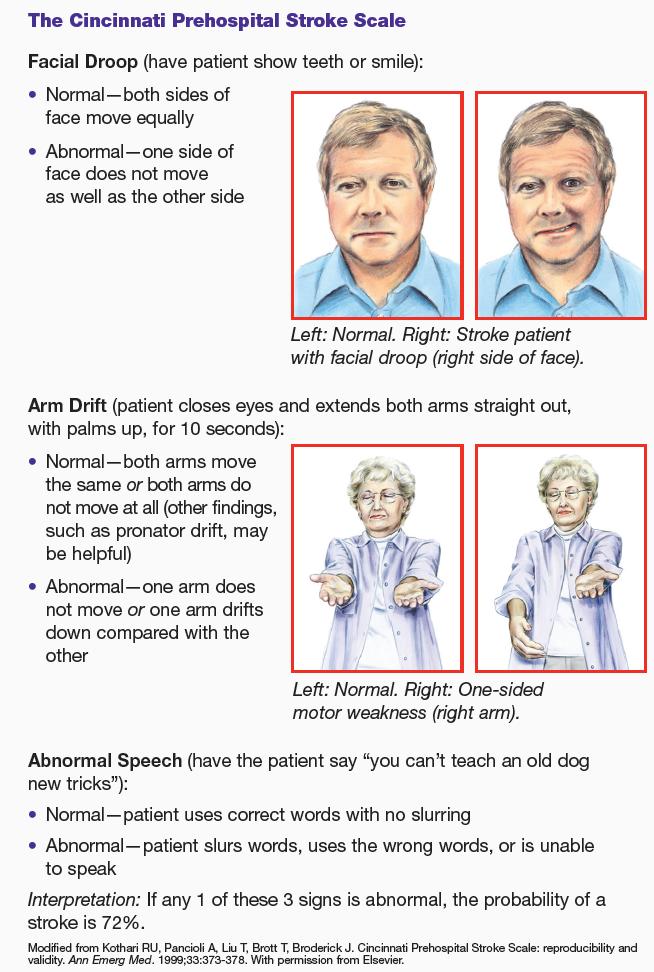 Stroke Scale